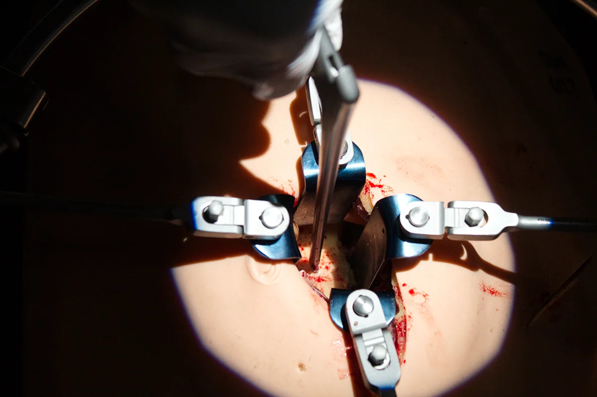 Anterior lumbar access on the RealSpine Lumbar Anterior Lateral