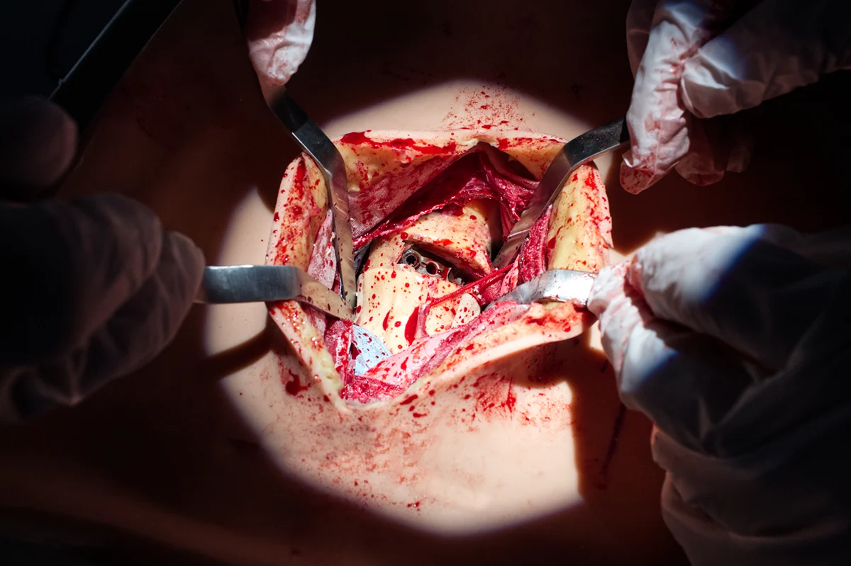 Implant placement training on the Lumbar Anterior Lateral